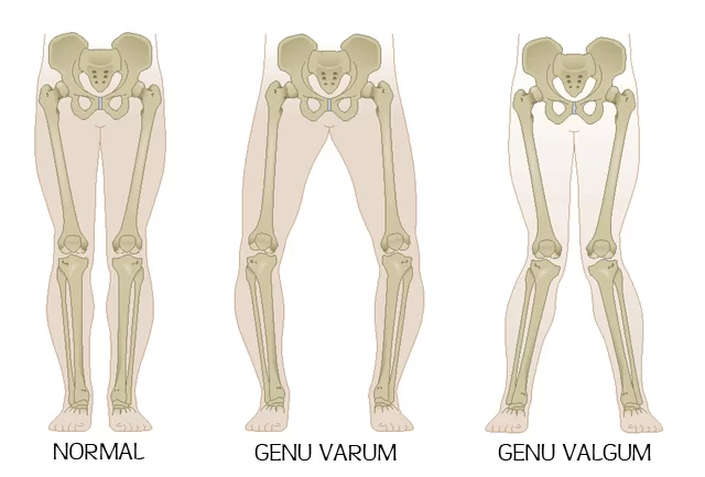 Les différentes morphologies des genoux, Genu varum, Genu Valgum et normal