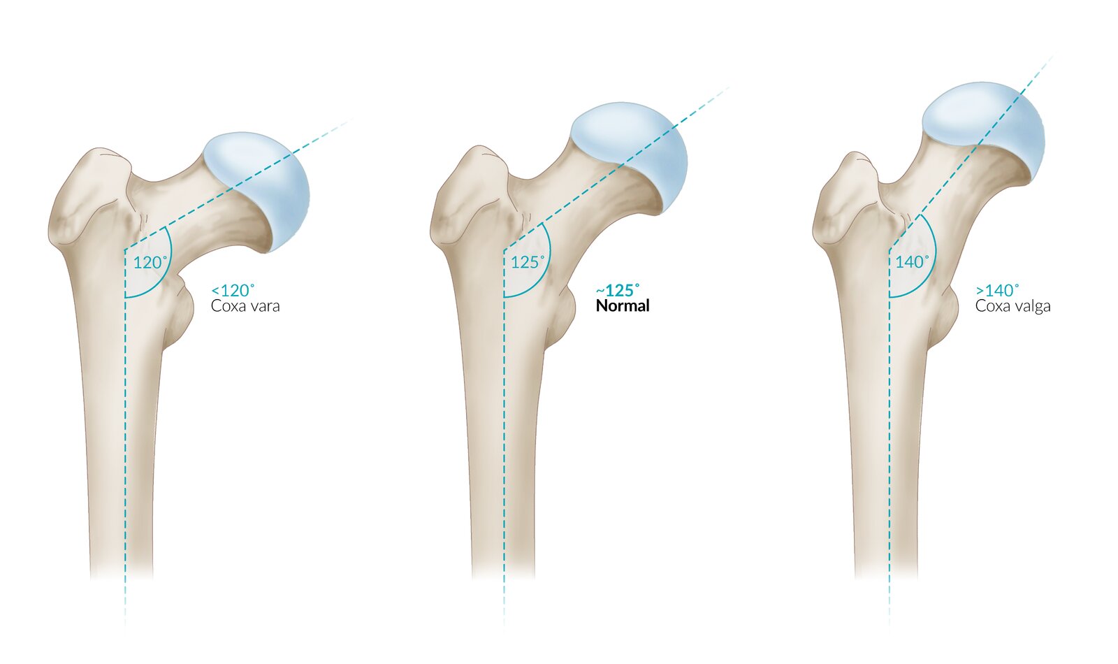 Les différentes morphologies de hanches, Coxa Vara et Coxa Valga